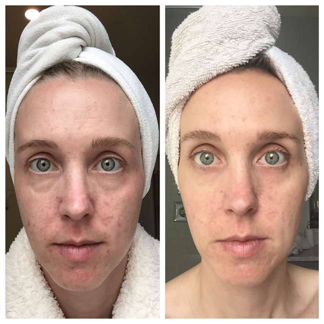 5 Weeks of using Umblemish picture for adult acne.