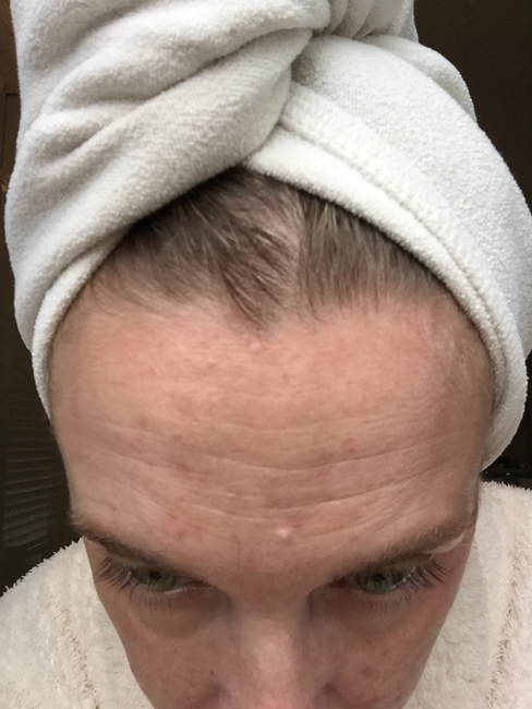 Before using Unblemish. I've been using Rodan + Fields Unblemish for a year, and have seen wonderful results. See the blog for a full year's worth of pictures!