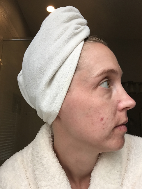 Before using Unblemish. I've been using Rodan + Fields Unblemish for a year, and have seen wonderful results. See the blog for a full year's worth of pictures!